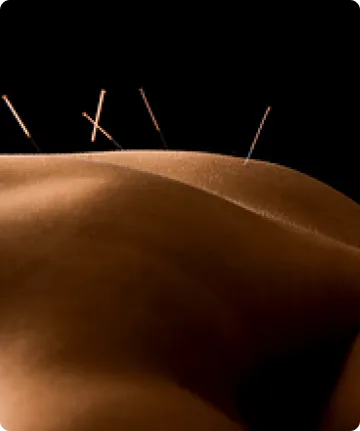 Akupunktur vs cupping-terapi: Hvad passer til dig?