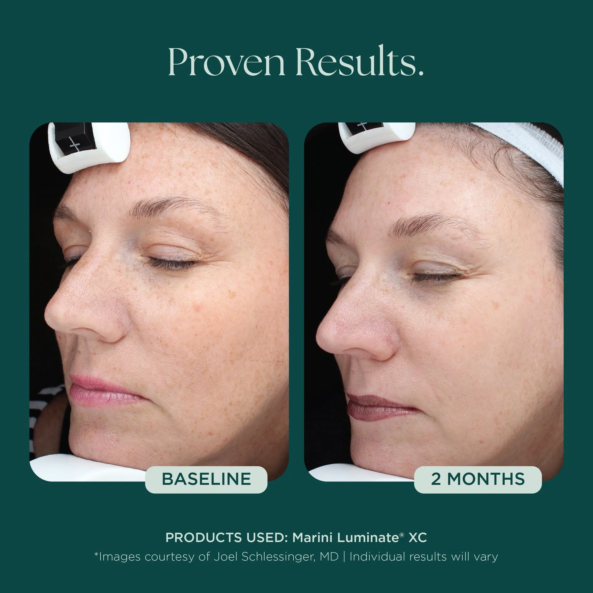 Marini Luminate® Ansigtslotion mod misfarvning og hyperpigmentering